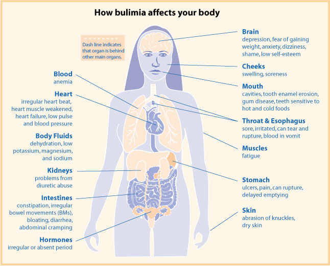 Difference Between Anorexia Nervosa And Bulimia Nervosa Definition Eating Pattern Consequences