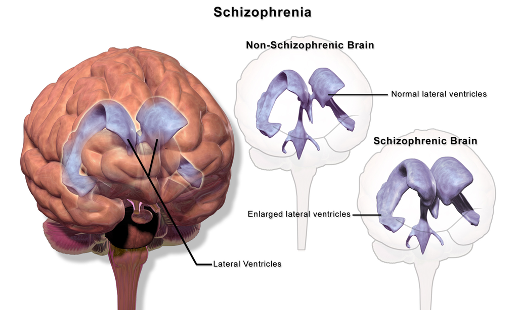 Can Bipolar Look Like Schizophrenia