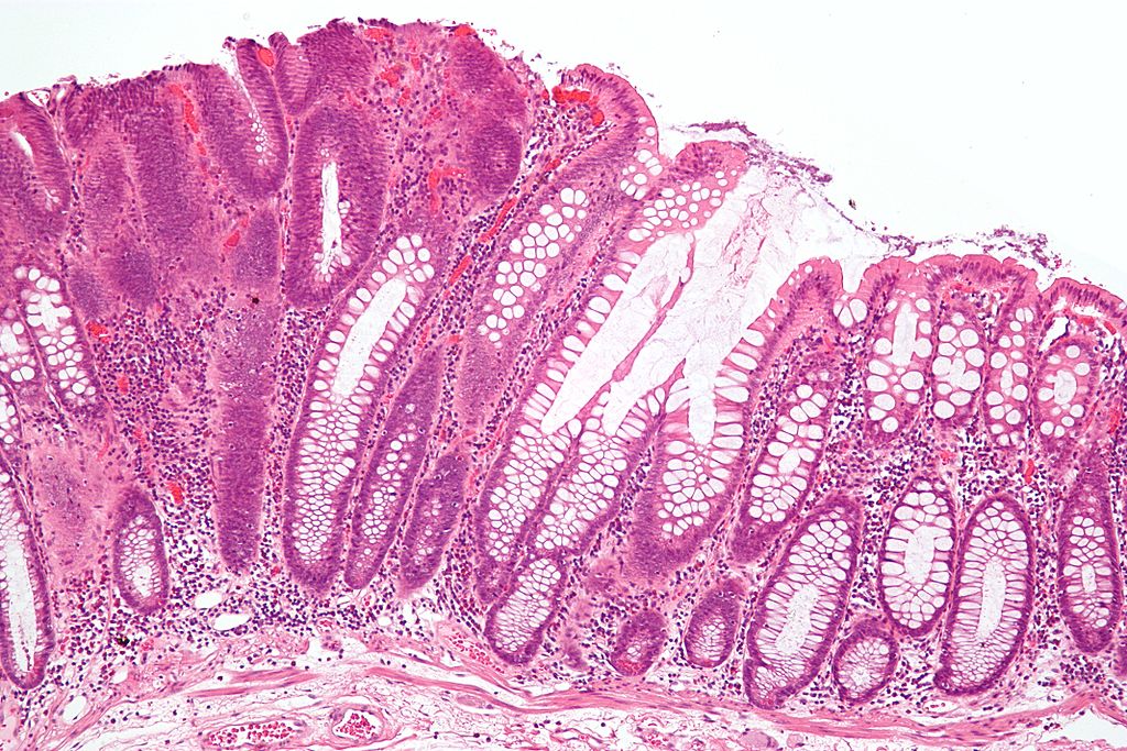 Difference Between Adenoma And Carcinoma Definition Types Causes 