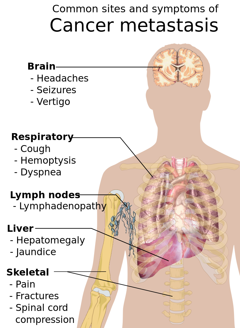 sarcoma 