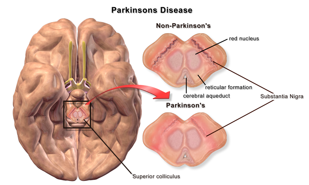 difference-between-parkinsonism-and-parkinson-s-disease-clinical