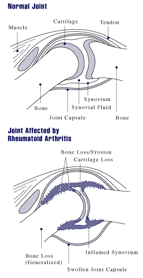 can methotrexate cause arthritis pain