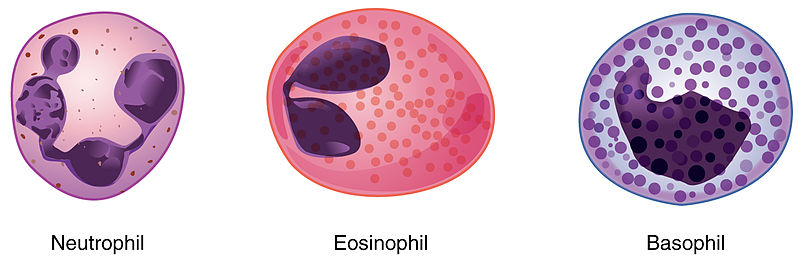 Eosinophils High eosinophil