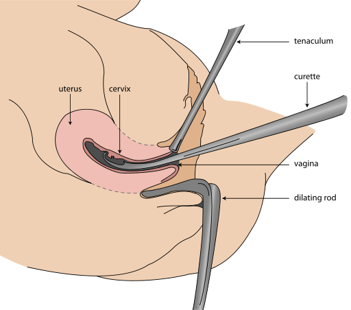 Difference Between Dilation and Dilatation