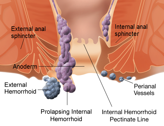 Main Difference - Pinworms vs Hemorrhoids