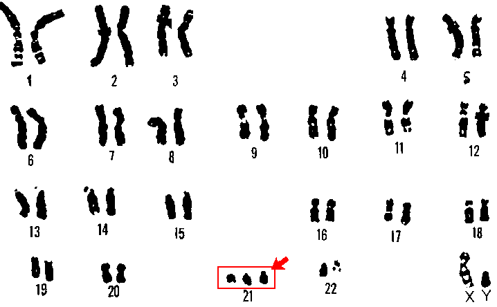 Main Difference - Trisomy vs Triploidy