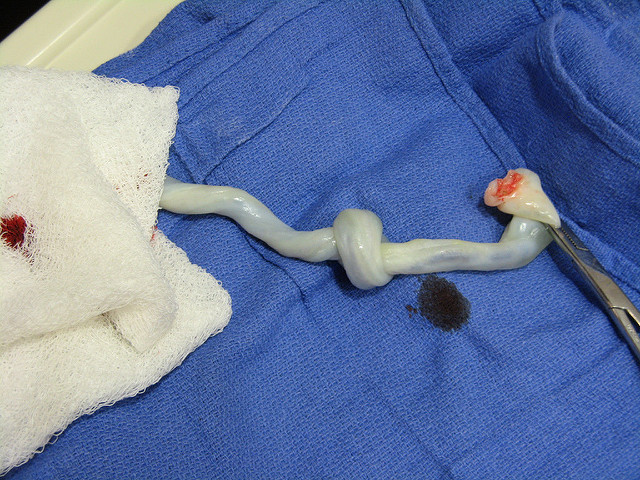 Main Difference - Cord Blood and Cord Tissue
