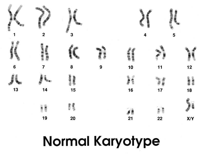 What Is The Difference Between Normal And Abnormal Karyotype Pediaa Com What Is The Difference Between Normal And Abnormal Karyotype Pediaa Com