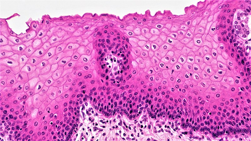 What Is The Difference Between Basal Cell And Squamous Cell – Pediaa.Com