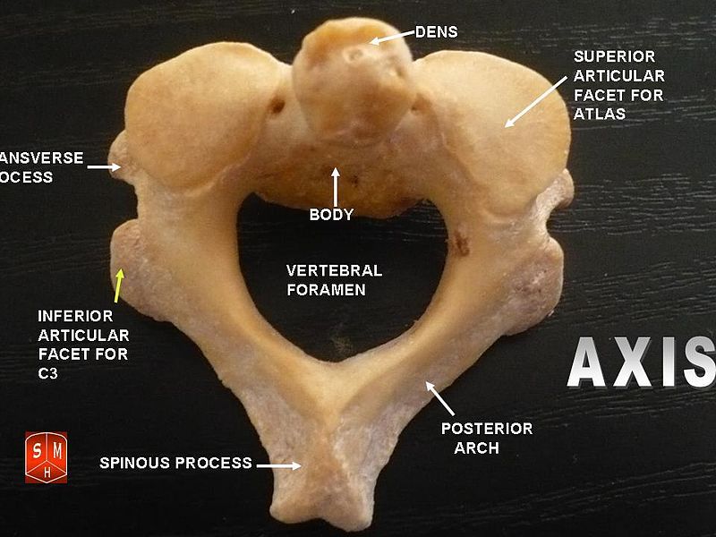What Is The Difference Between Atlas And Axis Vertebrae Pediaa