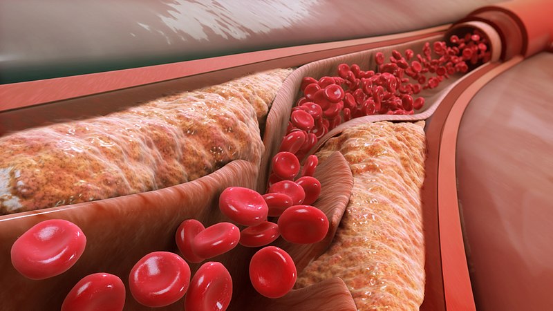 Difference Between VLDL and LDL