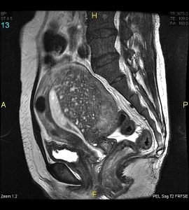 What Is The Difference Between Endometriosis And Adenomyosis Pediaa