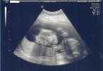 Difference Between Sonogram and Ultrasound - Foetus_sonogram