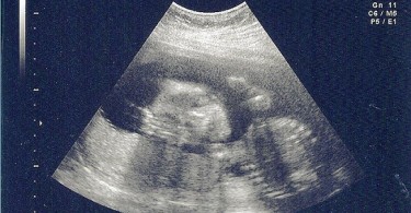 Difference Between Sonogram and Ultrasound - Foetus_sonogram