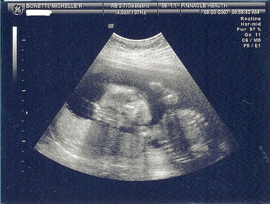 Difference Between Sonogram and Ultrasound - Foetus_sonogram