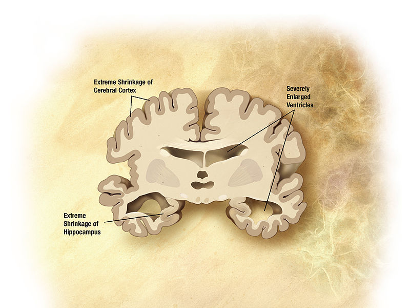 Main Difference - Dementia vs Alzheimer's
