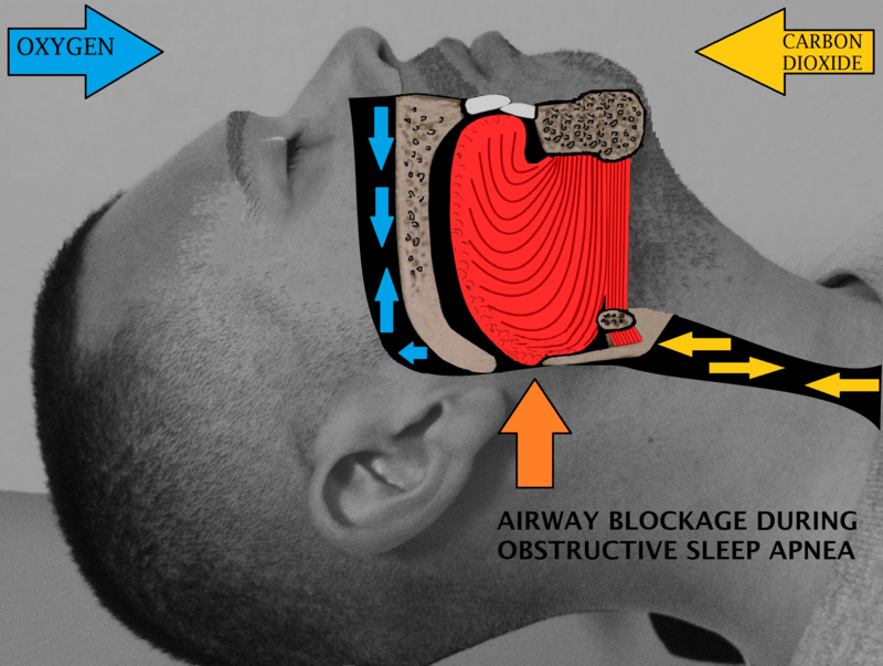 Difference Between Insomnia and Sleep Apnea Features, Signs and