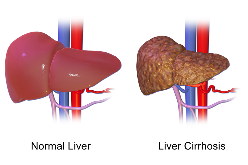 Key Difference -  Fibrosis vs  Cirrhosis