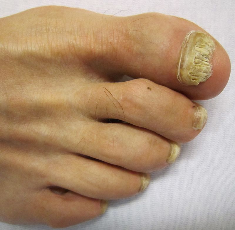 this-super-easy-2-ingredient-recipe-will-eliminate-your-nail-fungus