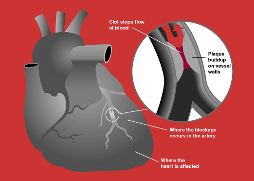 what-happens-during-a-heart-attack