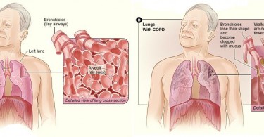 Emphysema Characteristics Archives - Pediaa.Com