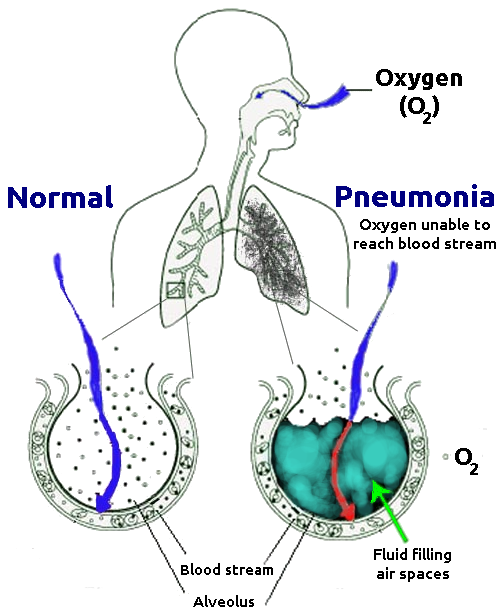 Difference Between Pneumonia and Pleurisy | Definition, Cause, Risk ...