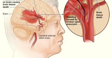 Stroke vs TIA Archives - Pediaa.Com