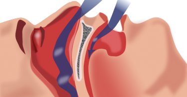 Difference Between Narcolepsy and Sleep Apnea