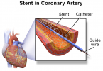 Difference Between Stent and Catheter