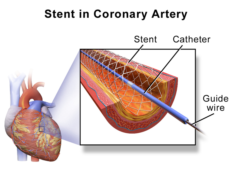 difference-between-stent-and-catheter-features-use-purpose