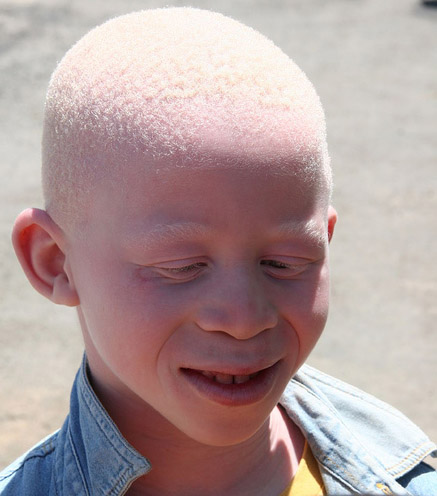 What Type of Mutation is Albinism | Types of Albinism, Gene Affected by