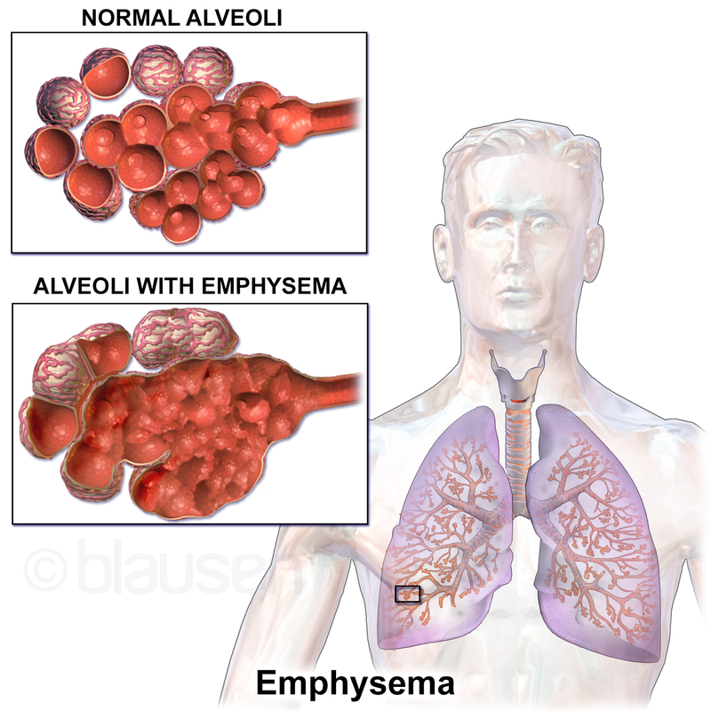 Image result for Emphysema