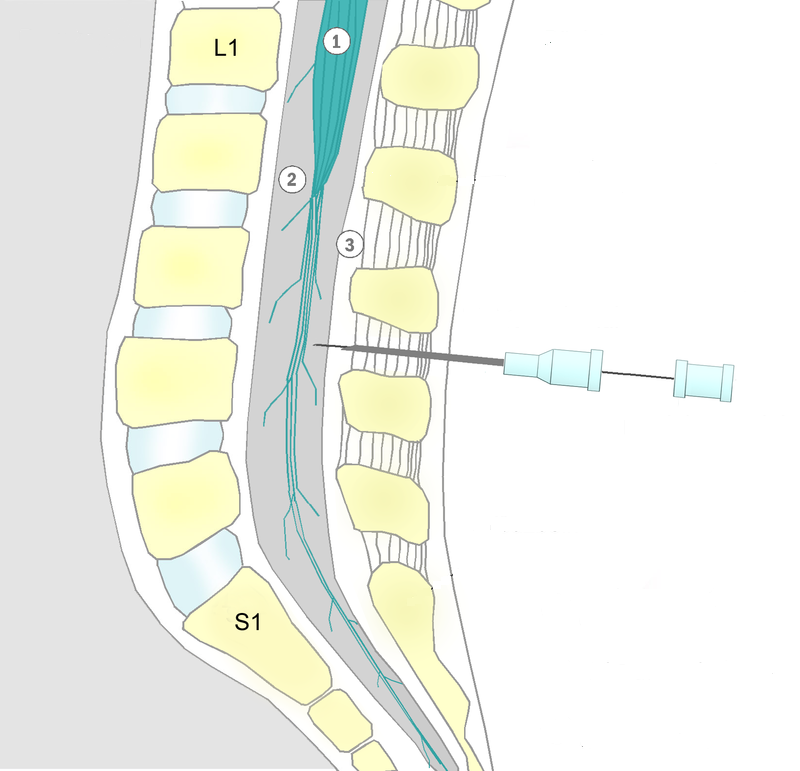 Difference Between Spinal and Epidural Anesthesia | Purpose, Procedure