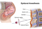 Difference Between Spinal and Epidural Anesthesia