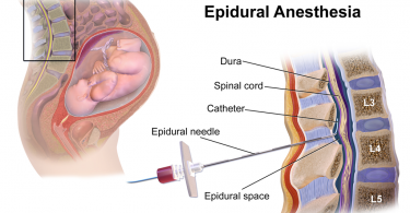 Difference Between Spinal and Epidural Anesthesia