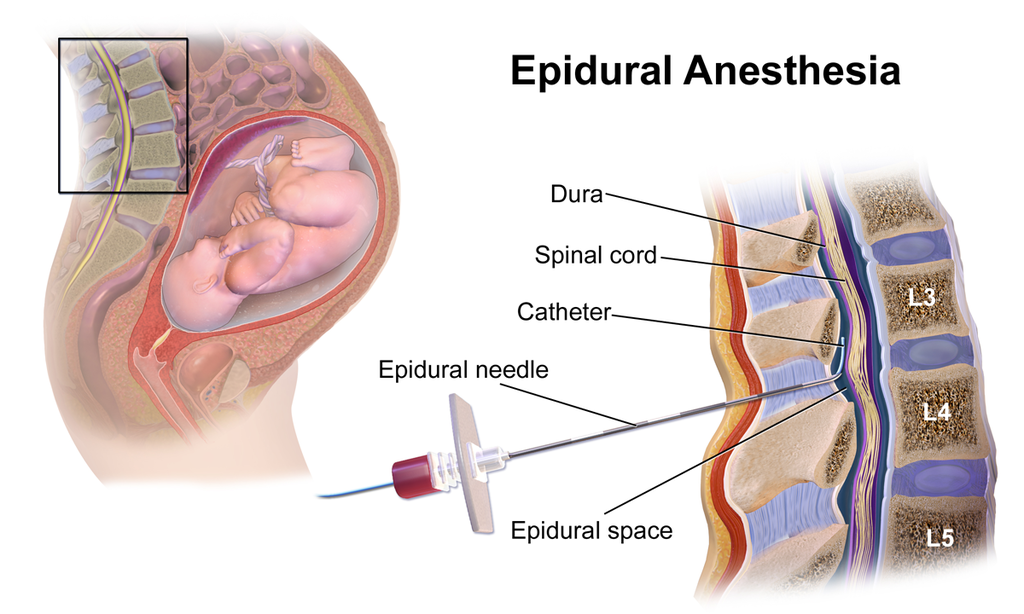 Difference Between Spinal And Epidural Anesthesia Purpose Procedure 