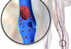 What Causes Deep Vein Thrombosis