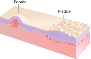 Difference Between Zit and Pimple | Features, Causes, Management and ...