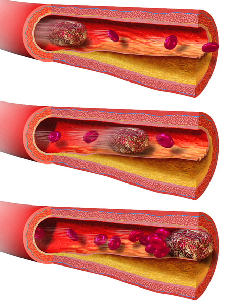 Difference Between Thrombus And Embolus Definition Facts Symptoms