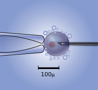 Difference Between ICSI and IVF