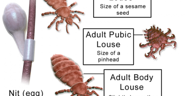 Difference Between Lice and Fleas