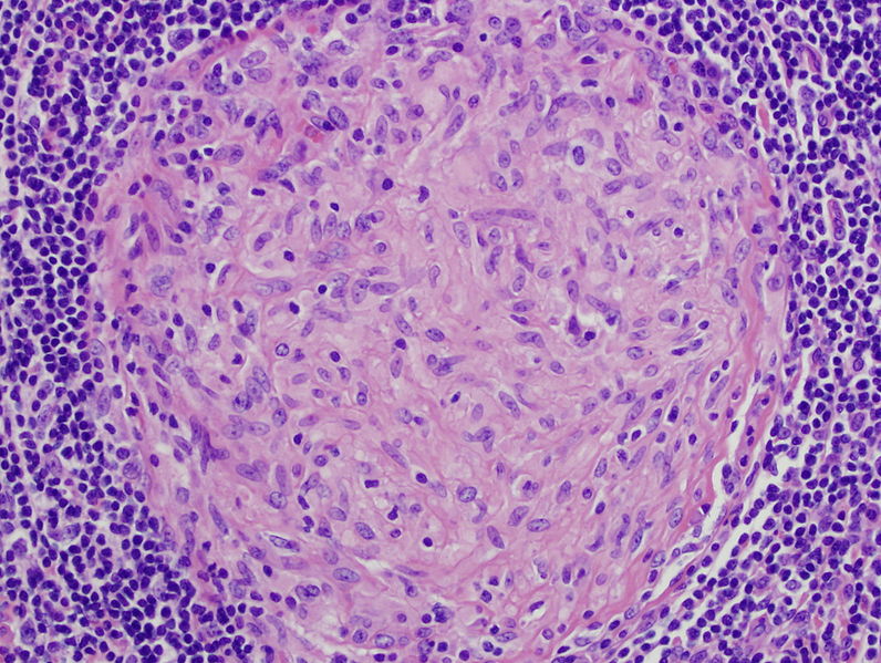 Main Difference - Granulation Tissue and Granuloma