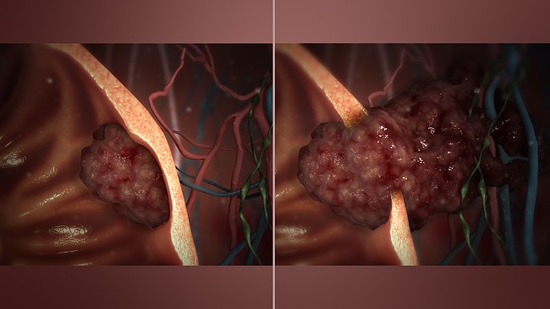 What is the Difference Between Invasion and Metastasis