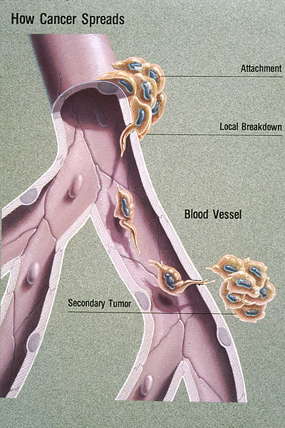 Difference Between Invasion and Metastasis