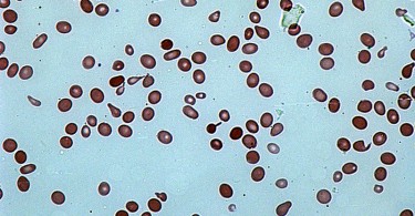 Difference Between Anisocytosis and Poikilocytosis