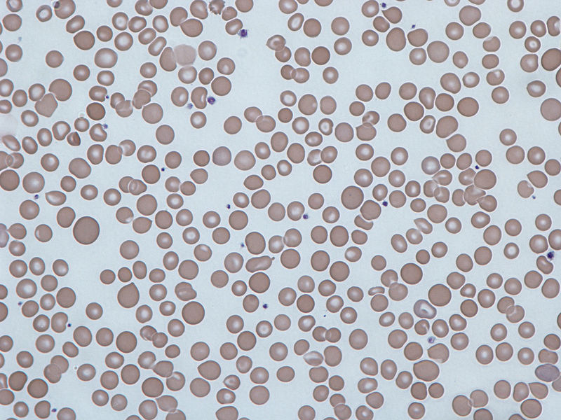 What is the Difference Between Anisocytosis and Poikilocytosis