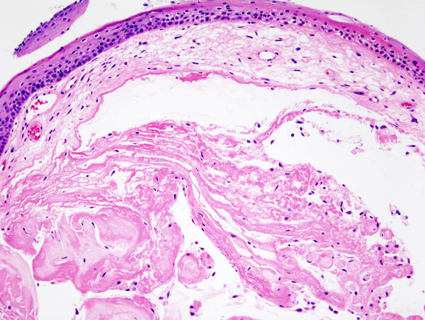 What is the Difference Between Nodule and Polyp