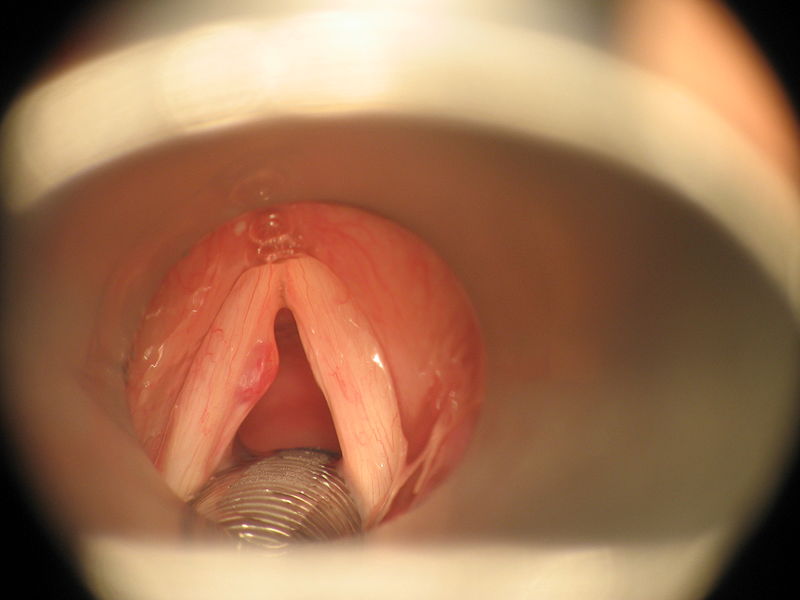 Difference Between Nodule and Polyp
