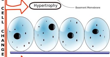 Hyperplasia vs Neoplasia Archives - Pediaa.Com