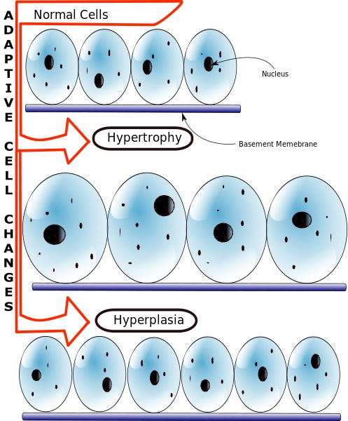 what-is-the-difference-between-hyperplasia-and-neoplasia-pediaa-com